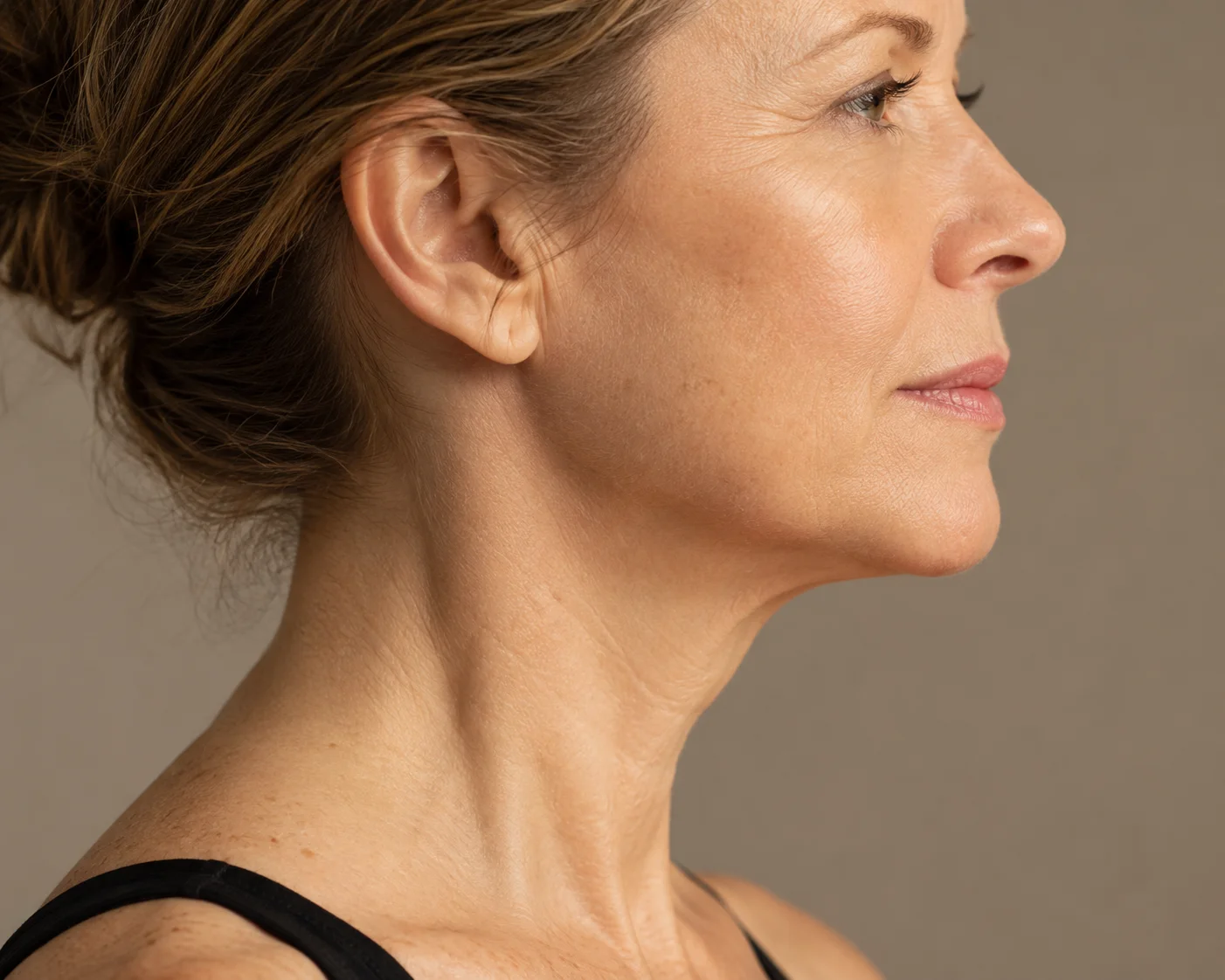 Deep Neck Lift Areas Treated